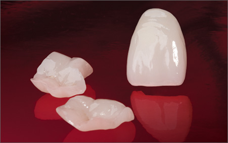 Ceramic and porcelain crowns in Tijuana.