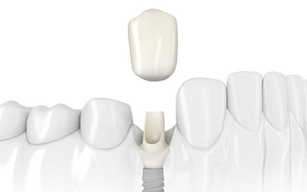 Dental Implants In Tijuana Tijuana DentistryTijuana Dentistry