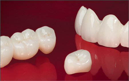 Zirconia Crowns and bridges in Tijuana